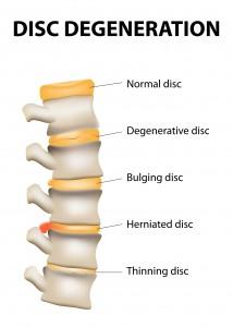 Herniated Disc Treatment Vancouver WA