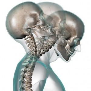 Whiplash Treatment Vancouver WA